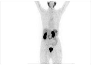 Targeted Alpha PSMA Therapy in India