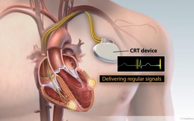 Cardiac resynchronization therapy Cost In India
