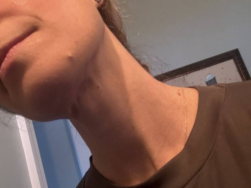 Woman with pimple on chin