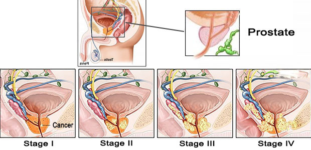 Prostate cancer staging