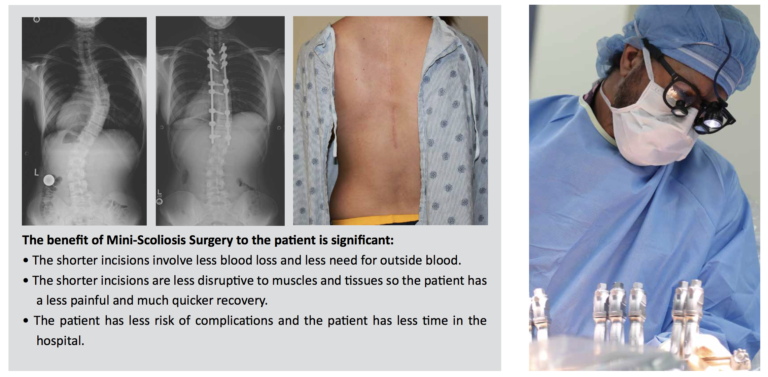 benefits of scoliosis surgery in India