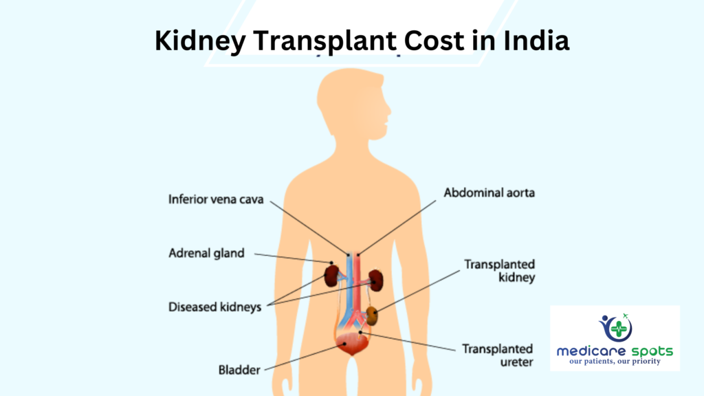 Kidney Transplant Cost in India
