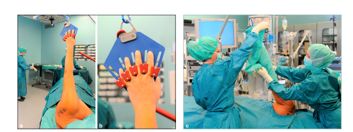 shoulder arthroscopy Surgery?